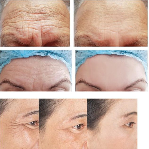 botox