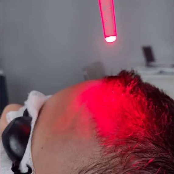 terapia capilar